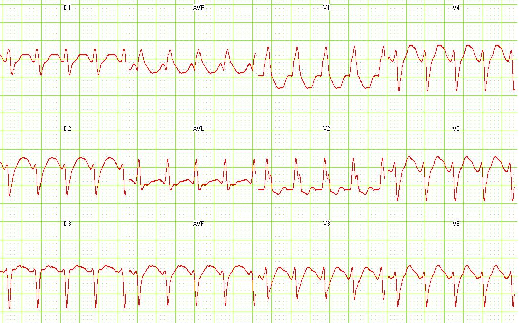 12 lead EKG: Ventricular tachycardia.