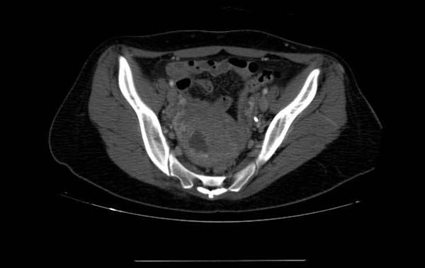 File:Gravid-uterus-CT-002.jpg