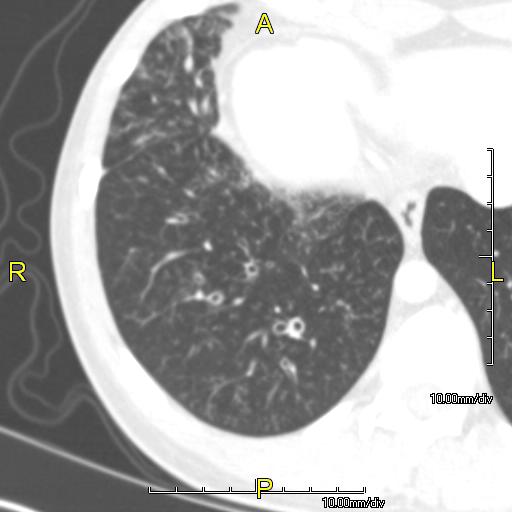 CT image showing dilated and thickened medium sized airways (bronchiectasis)in a patient with Kartagener syndrome