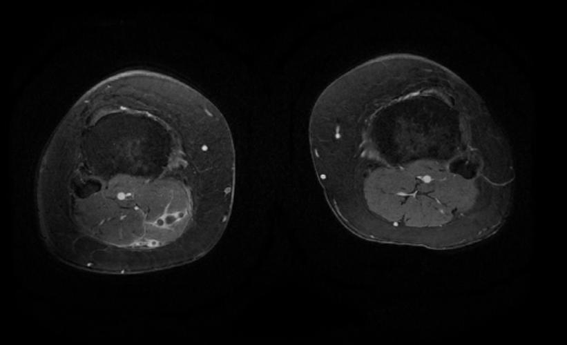 MRI: Superficial vein thrombosis