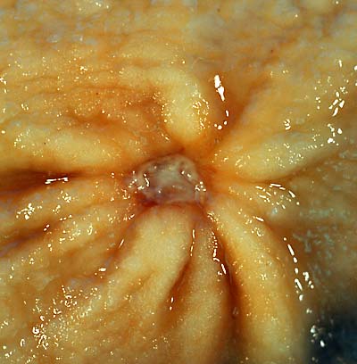 A benign gastric ulcer (from the antrum) of a gastrectomy Source:https://commons.wikimedia.org/wiki/File:Benign_gastric_ulcer_1.jpg#/media/File:Benign_gastric_ulcer_1.jpg