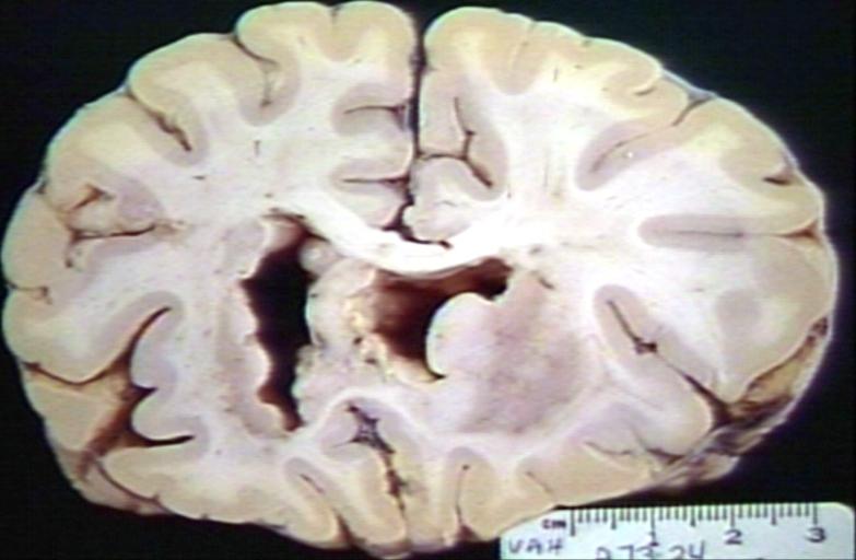 Brain: Oligodendroglioma; Ventricular Cobblestone Effect