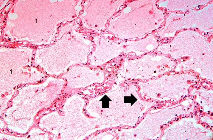 This high-power photomicrograph illustrates the edema fluid within the alveoli (1) and the congestion (RBCs) in the alveolar capillaries (arrows).