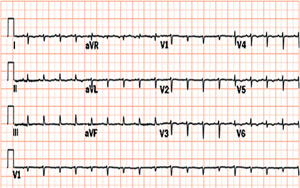 The above 12 lead EKG shows cardiac tamponade with electrical alternans