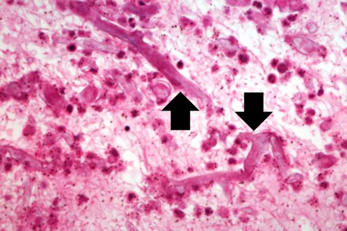 This is an even higher-power photomicrograph of the thrombus stained to outline the Mucor organisms (arrows).