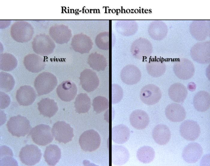 These thin film Giemsa stained micrographs show ring-form Plasmodium vivax and P. falciparumtrophozoites Adapted from Public Health Image Library (PHIL), Centers for Disease Control and Prevention.[6]