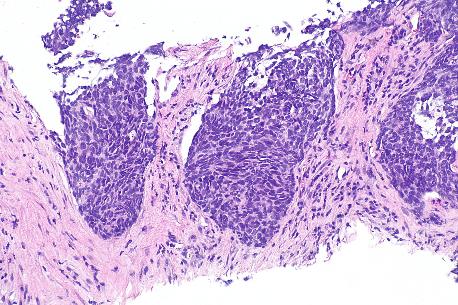 Micropathology non-small cell lung cancer