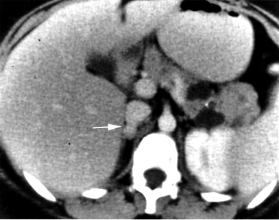 Pheochromocytoma. CT abdomen.