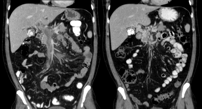 Portal vein thrombosis on computed tomography (left) and cavernous transformation of the portal vein after 1 year (right)