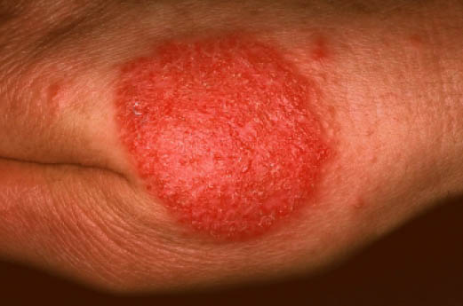 File:Nummular dermatitis eczematous.jpg