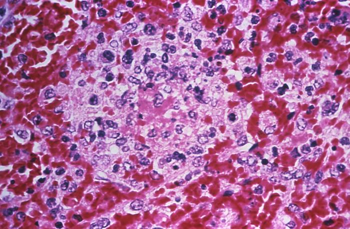 Photomicrograph depicting the histopathologic changes in splenic tissue in a case of fatal human plague; Mag. 400X Adapted from Public Health Image Library (PHIL), Centers for Disease Control and Prevention.[18]