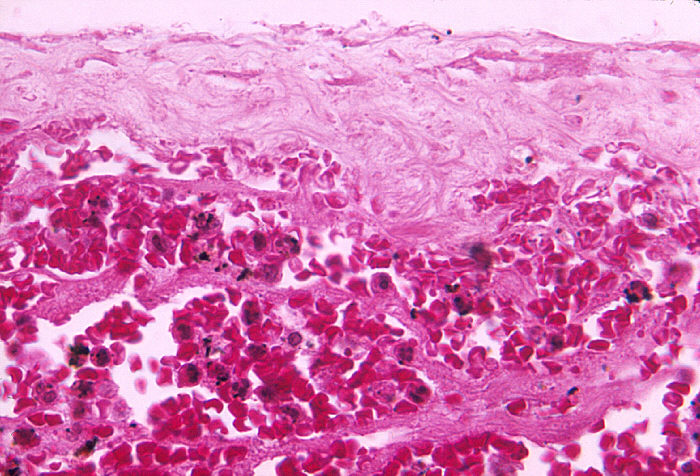 "Photomicrograph of meninges demonstrating hemorrhage due to fatal inhalation anthrax”Adapted from Public Health Image Library (PHIL), Centers for Disease Control and Prevention.[21]