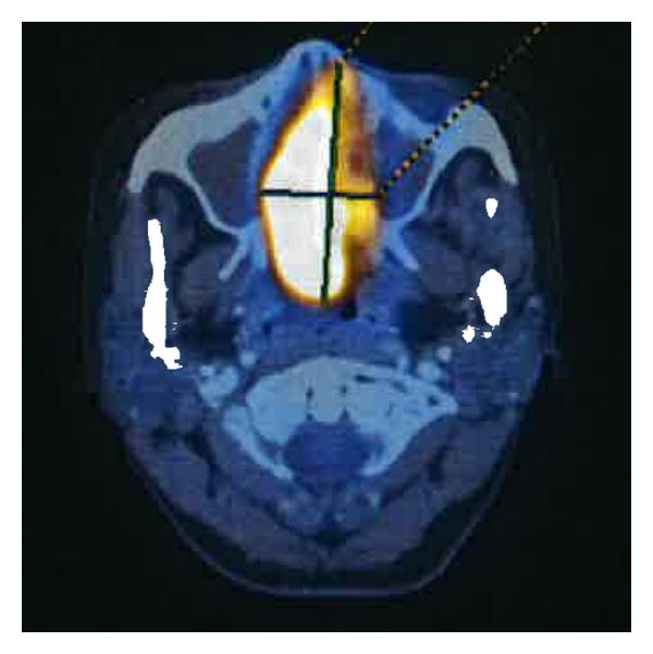 PET/CT scan of a patient with NK/T-cell lymphoma showing a FDG-avid mass in the right nasal cavity.[2]