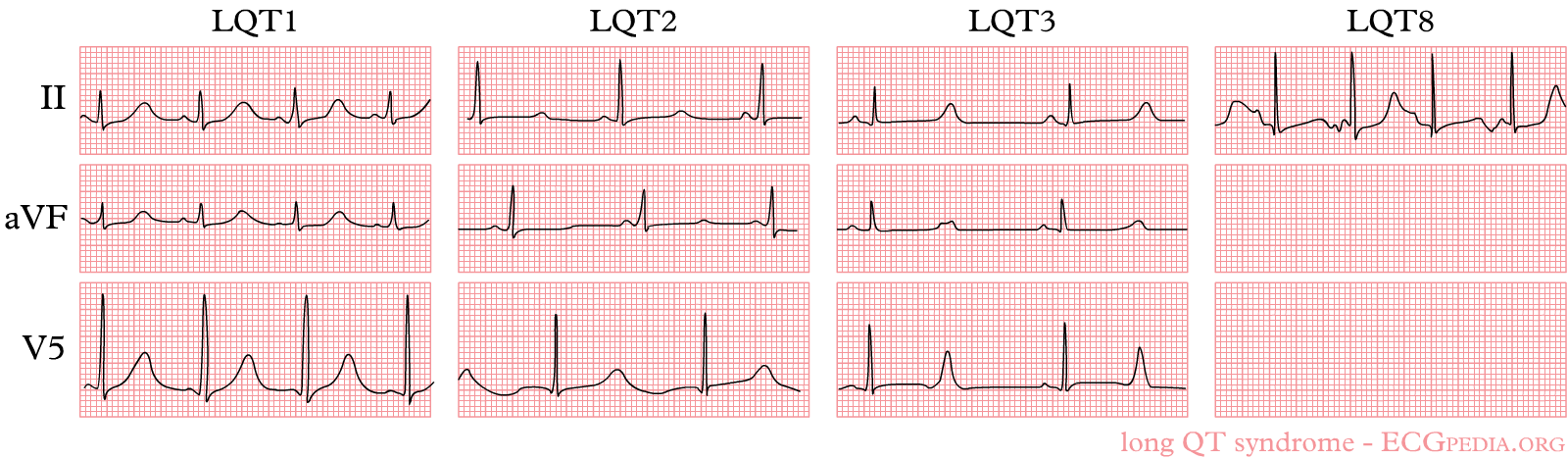The three most common forms of LQTS can be recognized by the characteristic ECG abnormalities
