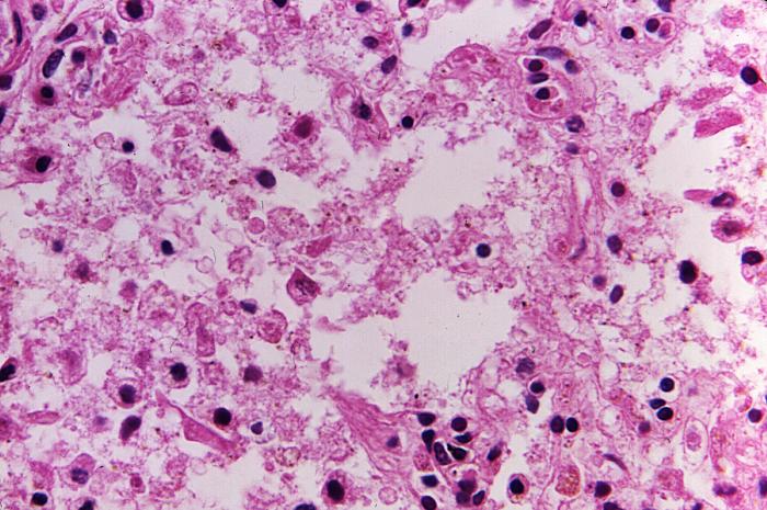 Magnification of 500X, this hematoxylin and eosin-stained (H&E) lung tissue sample revealing the histopathologic changes indicative of what was diagnosed as a case of fatal human plague from the country of Nepal. Adapted from Public Health Image Library (PHIL), Centers for Disease Control and Prevention.[18]