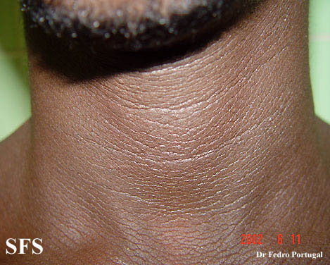 Acanthosis nigricans benign. Adapted from Dermatology Atlas.[2]