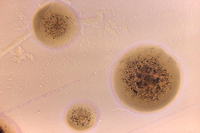 Actinomycosis bovis. From Public Health Image Library (PHIL). [1]
