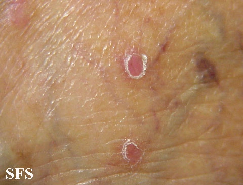 Lichen planus vesicular . Adapted from Dermatology Atlas.[1]