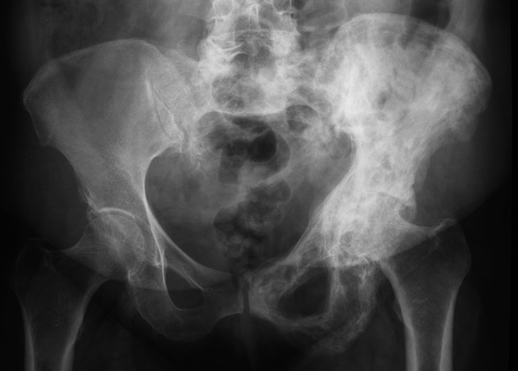 File:Paget-disease-of-bone-5.jpg