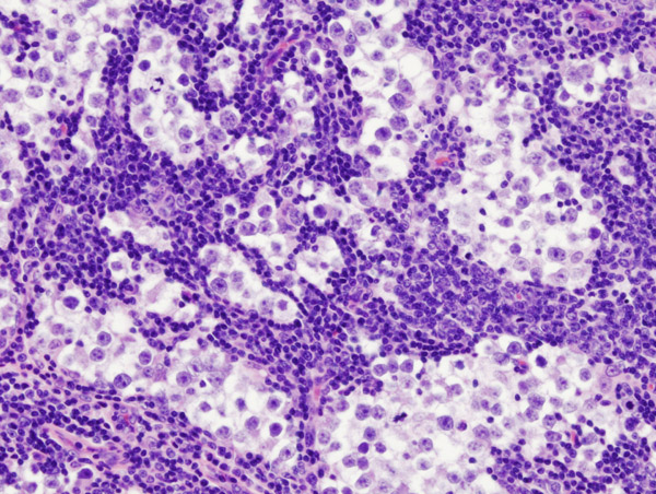 Histopathological image of metastatic seminoma in the inguinal lymph node on hematoxylin & eosin stain.[2]