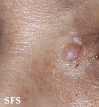File:Trichoblastoma02.jpg