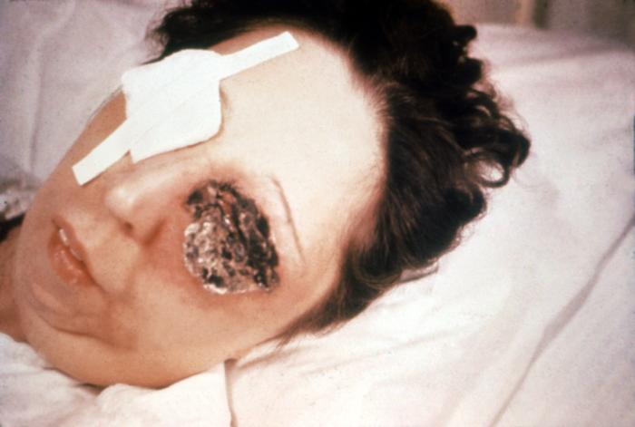 Female patient shown here on the 5th day of a Bacillus anthracis infection involving her left eye.”Adapted from Public Health Image Library (PHIL), Centers for Disease Control and Prevention.[20]