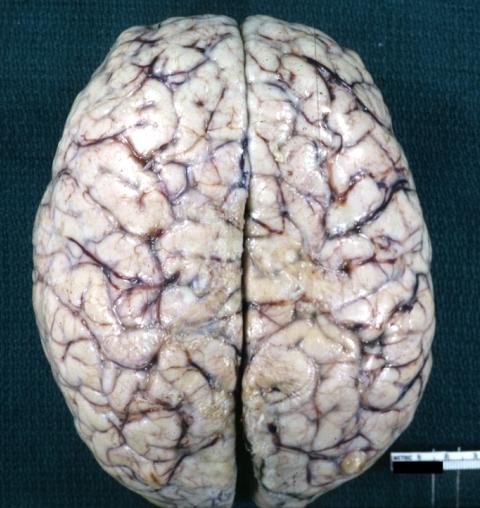 Brain: Pontine Glioma and Diffuse Meningeal Gliomatosis in 7 yo boy: Gross; fixed tissue, view of cerebral hemispheres from vertex meningeal gliomatosis.