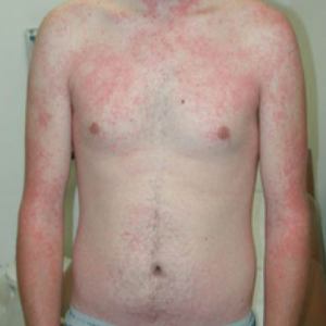 File:Leptospirosis rash.jpg