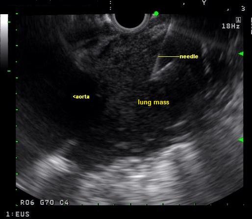 Endoscopic ultrasound: A biopsy window is found and an fine needle aspiration advanced into the mass