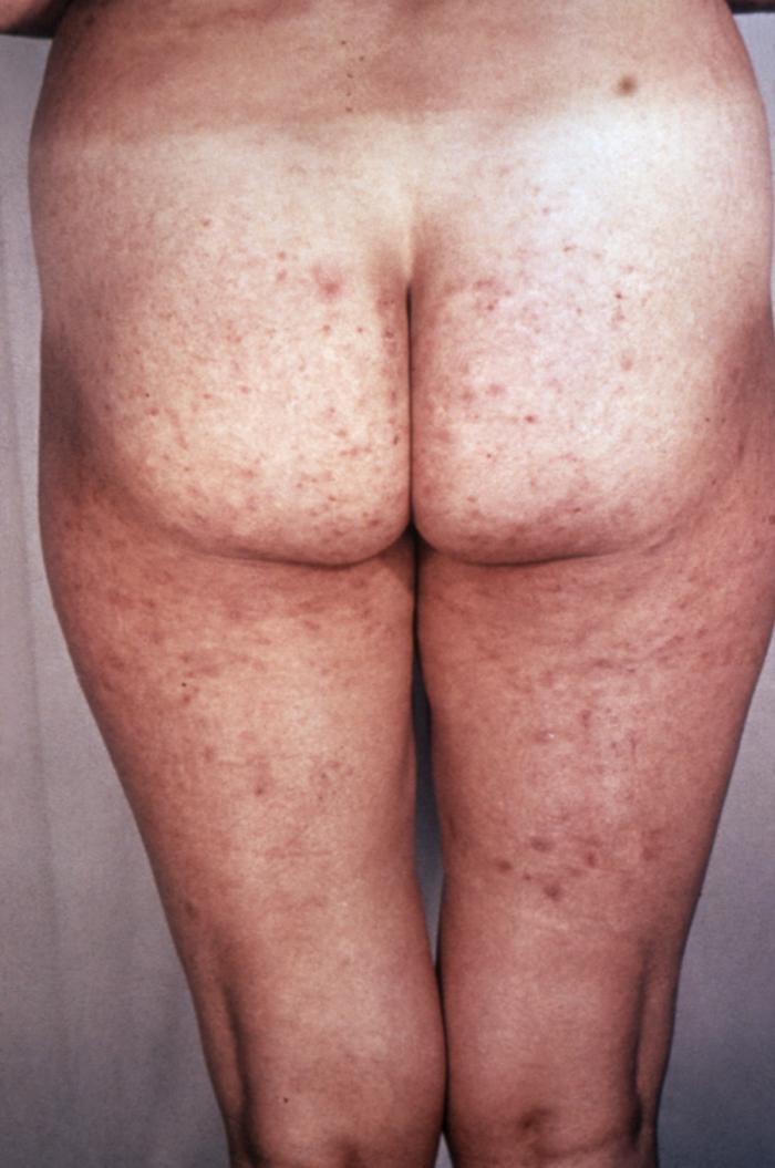 “Roseola rash” developed on syphilis patient buttocks and legs during the secondary stage of the disease. From Public Health Image Library (PHIL). [2]