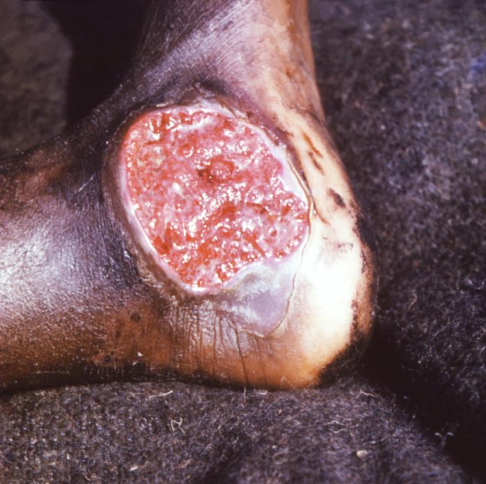 Acute tropical ulcer caused by fusiform bacilli and spirochetes. From Public Health Image Library (PHIL). [10]