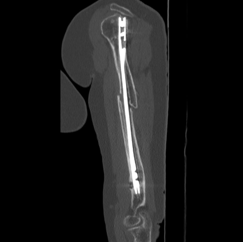 Sagittal bone window- Fracture of the middle third of the humerus, with small shifting and no signs of consolidation.