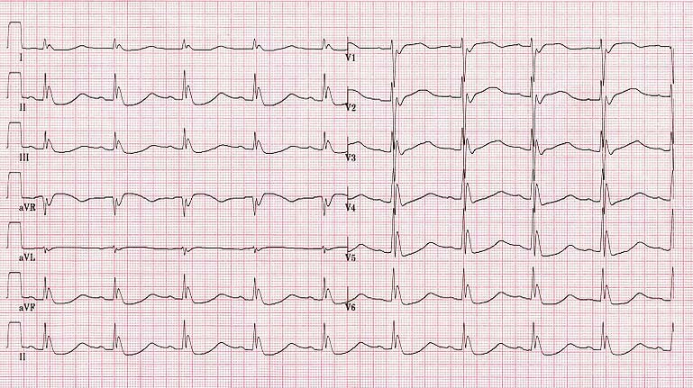An ECG of a patient with a body temperature of 28 degrees Celsius.