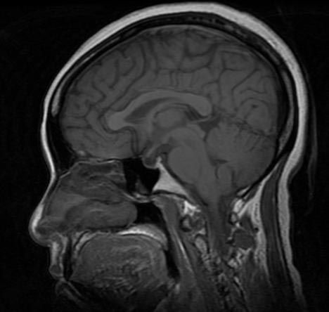 File:Normal-brain-MRI-006.jpg
