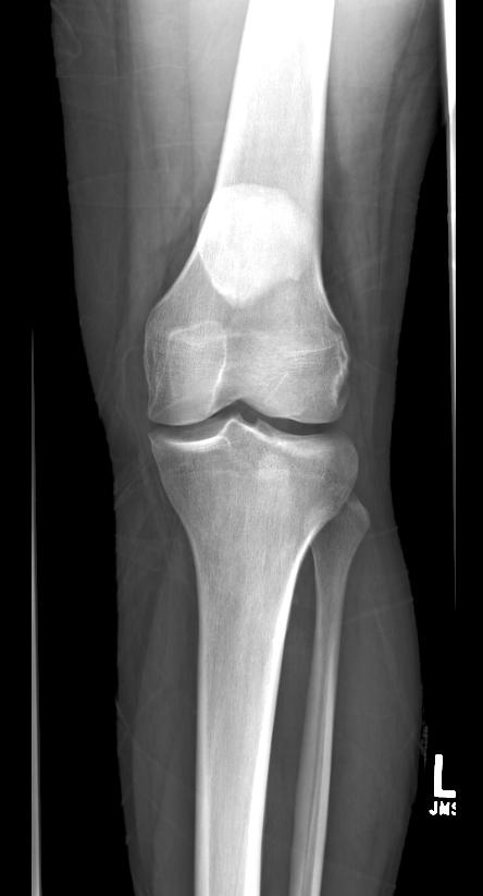X-ray: Patella alta secondary to patellar tendon rupture