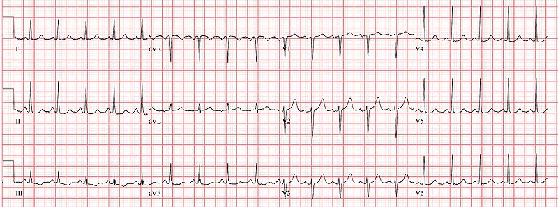 EKG shows sinus tachycardia, source: courtesy of ECGpedia, http://en.ecgpedia.org/wiki/File:Sinustachycardia.jpg