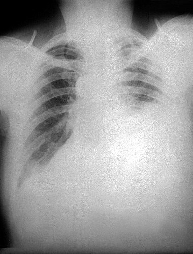 PA chest radiograph of anthrax, 13th day of illness. Adapted from Public Health Image Library (PHIL), Centers for Disease Control and Prevention.[4]