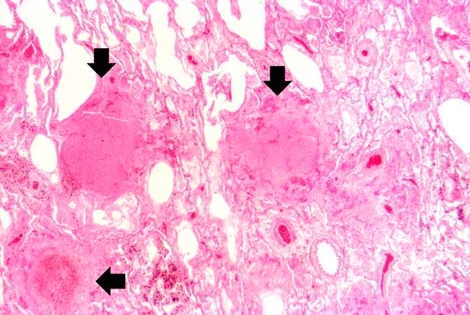 This higher-power photomicrograph of the eosinophilic nodules (arrows) illustrates their discreet nature and the surrounding inflammatory response in the remaining normal lung tissue.