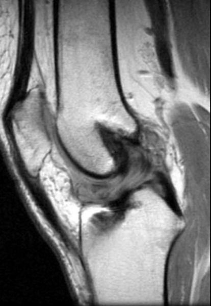 File:Disruption-of-ACL-graft-with-cyclops-lesion-002.jpg