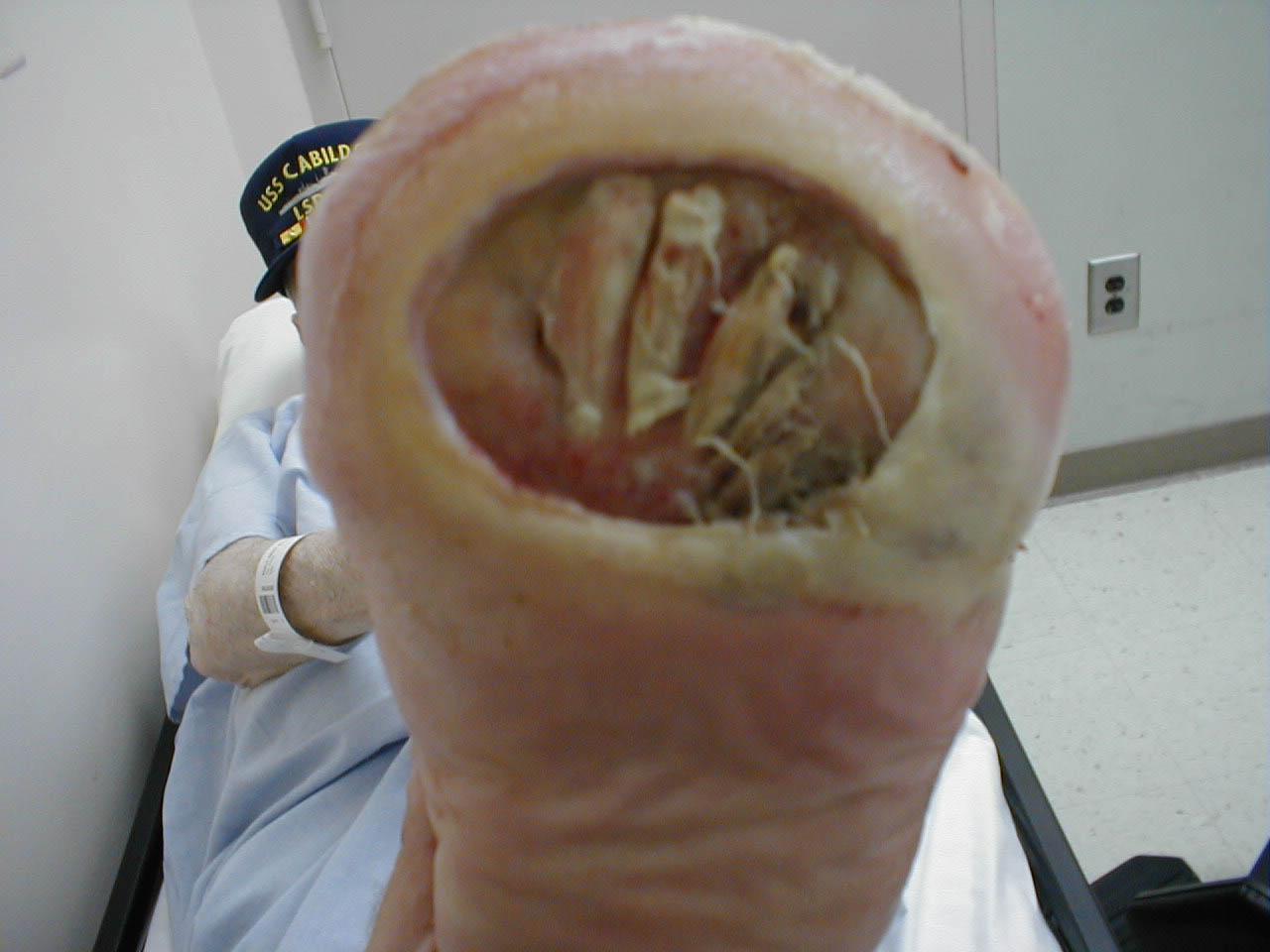 Diabetes induced neuropathy has lead to large, painless ulcer on bottom of foot. Patient has had toes removed several years earlier due to prior infection.