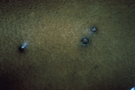 Bacillary Angiomatosis Image obtained from U.S. Department of Veterans Affairs - Image Library [16] (Paul A. Volberding, MD, University of California San Francisco)