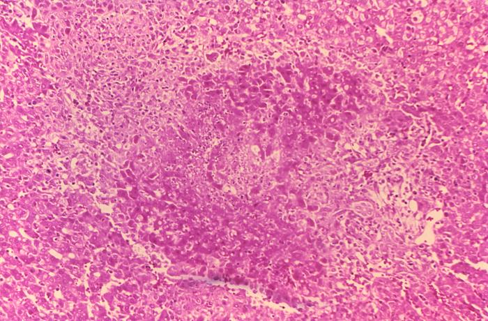 Histopathology of guinea pig liver in experimental Brucella suis infection. Granuloma with necrosis.