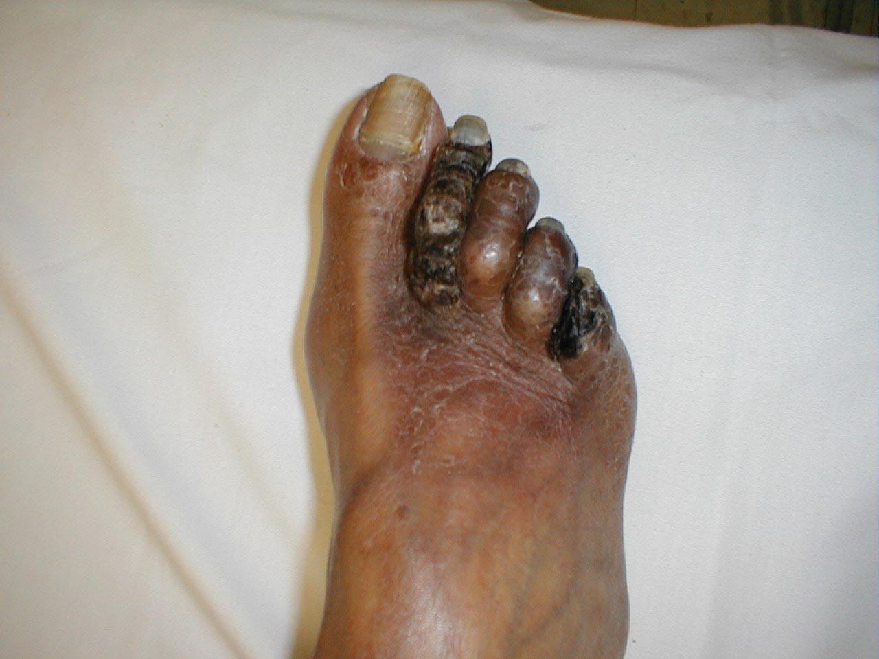 Patient with peripheral vascular disease that has lead to infarct of several toes.