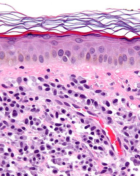 File:Mastocytosis Histology.jpg