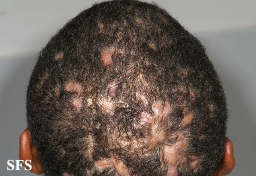 Perifolliculitis capitis. With permission from Dermatology Atlas.[4]