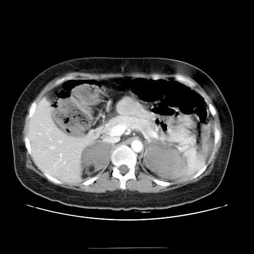 Computed Tomography: Adrenal hemorrhage