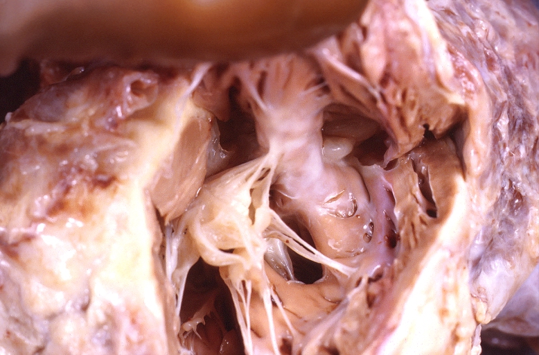 Congenital heart disease, artrio-ventricular (AV) canal