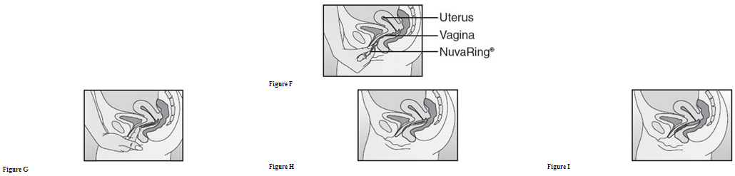 File:Etonorgestrel and Ethinyl Estradiol Vaginal Ring Image4.png
