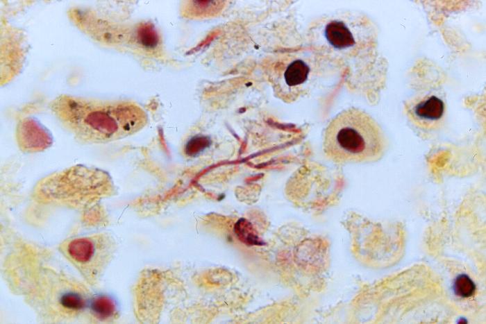 High magnification of 1200X, this Brown and Brenn-stained lung tissue sample revealing the histopathologic changes indicative of what was diagnosed as a case of fatal human plague from the country of Nepal. Adapted from Public Health Image Library (PHIL), Centers for Disease Control and Prevention.[19]