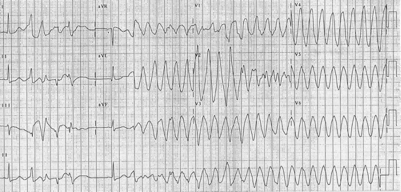 A 12 lead ECG recording example of TdP[7]